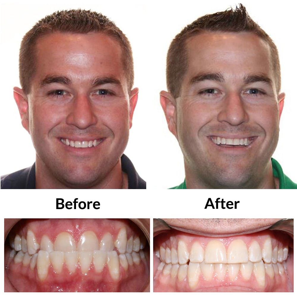 Adult Invisalign Before and After