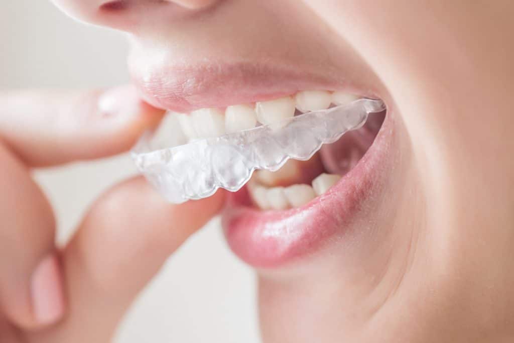 Could I Be a Candidate for Clear Aligners?