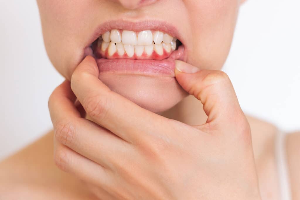 How Gum Disease Progresses and When Treatment is Needed