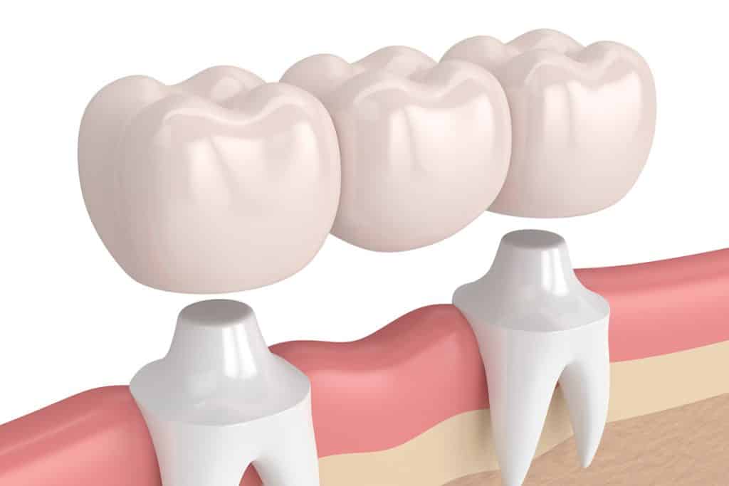 How Long Does a Dental Bridge Last?