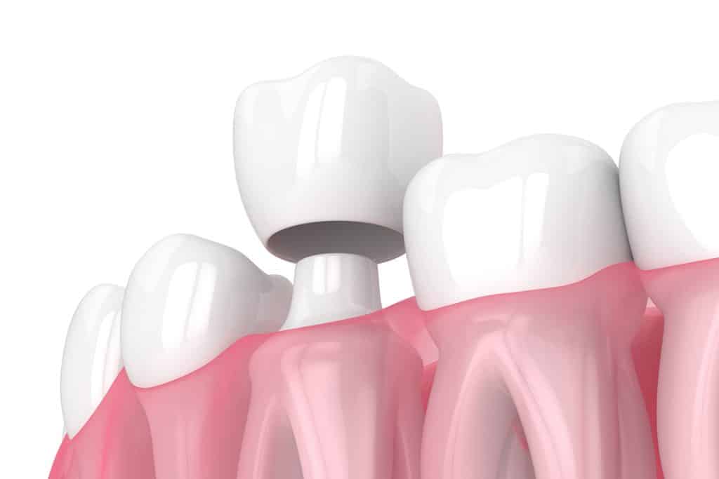 How Much Tooth Is Needed for a Dental Crown?