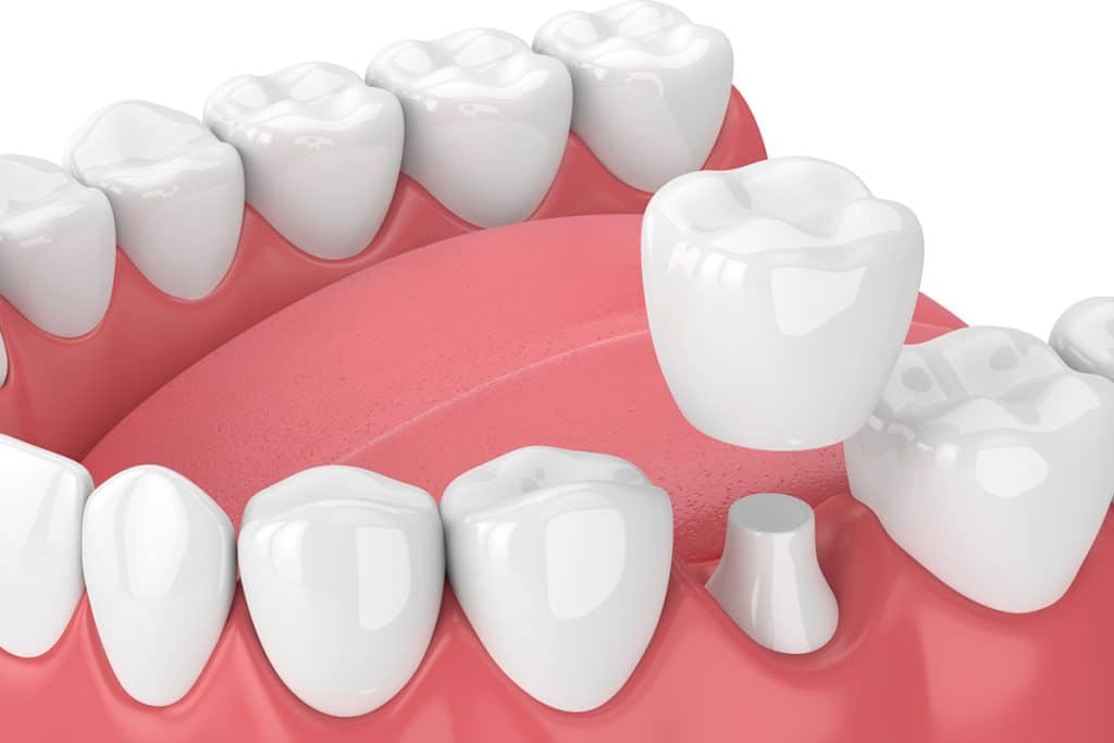 How Same-Day Crowns Can Transform Your Smile in Just One Visit