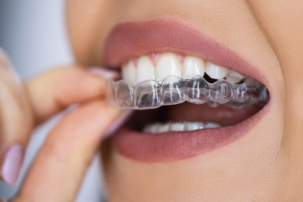 Top 5 Myths About Clear Aligners Debunked